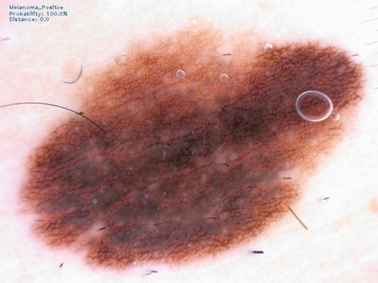 Melanoma Detection
